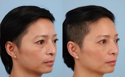 Woman treated with Restylane - Woman treated with Restylane onher cheeks and tear troughs