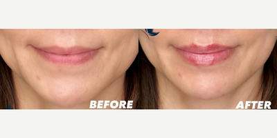 Woman treated with Restylane Kysse, Juvederm - Woman treated with Restylane Kysse for her lips and Juvederm for her chin