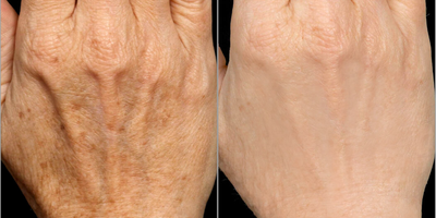 65-74 year old woman treated with Hand Rejuvenation - 67-year-old female underwent CO2 Laser Resurfacing (Pixel Perfect) with PRP (Platelet-Rich Plasma) treatment to the hands.
