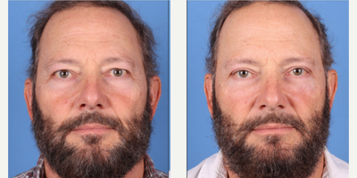 55-64 year old man treated with Eyelid Surgery, Bellafill - Upper and lower blepharoplasty with bellafill to tear traughs