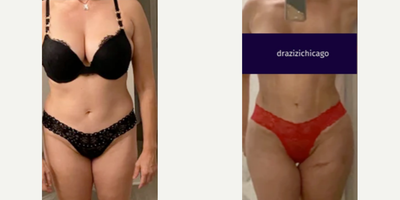 Woman treated with Brazilian Butt Lift - Woman treated with 360 Vaser Liposuction with J-Plasma as well as Brazilian Butt Lift