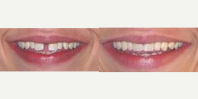 35-44 year old woman treated with Six Month Smiles - Before and after 6 month smiles