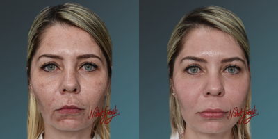 35-44 year old woman treated with PicoSure - PicoSure is a laser technology used to treat skin pigmentation issues, tattoos, scars, and blemishes. It operates using ultra-short (picosecond) laser pulses, breaking down pigmentation for the body to naturally clear. It's known for potentially delivering effective results in fewer sessions compared to other laser systems. PicoSure may reduce the appearance of spots, tattoos, or marks while promoting younger-looking, smoother skin by stimulating collagen production. Treatment duration varies based on individual skin conditions and goals. Consulting a dermatologist or specialist before using this technology is crucial.