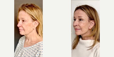 Woman treated with Facelift, Deep Plane Facelift, Brow Lift - And another beautiful DEFINE LIFT PLUS. This is a 72yo female that looks rejuvenated and age appropriate. Its subtle and natural in everyway from her elevated cheeks to improved jawline and cheek. If a fundamental beautiful age defying procedure had a name it would be the DEFINE LIFT!