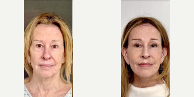 Woman treated with Facelift, Deep Plane Facelift, Brow Lift - And another beautiful DEFINE LIFT PLUS. This is a 72yo female that looks rejuvenated and age appropriate. Its subtle and natural in everyway from her elevated cheeks to improved jawline and cheek. If a fundamental beautiful age defying procedure had a name it would be the DEFINE LIFT!