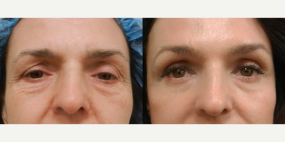 Brow Lift - These are pictures of a Brow Lift and Lower Blepharoplasty. The Art of Plastic Surgery, Dr. Gregory A. Wiener, MD FACS