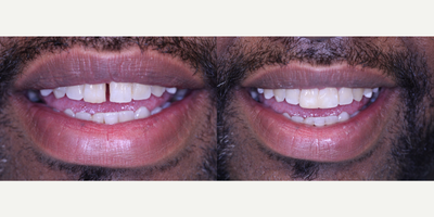 Closing Diastema space between central incisors with Dental Bonding - Closing Diastema space between central incisors with Dental Bonding