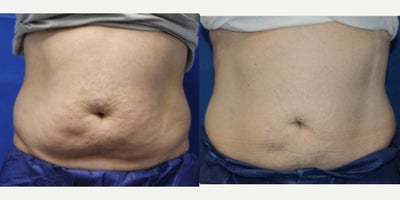 45-54 year old woman treated with CoolSculpting Elite - 45-54 year old woman treated with CoolSculpting Elite