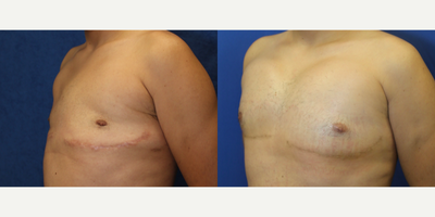 35-44 year old man treated with Pec Implants - This is a 37 year old male patient who is 5'5 and 145 pounds. In 2007, he had raw silicone injected in his pectoral area which caused him problems. In November 2021, this patient traveled from Chicago to Beverly Hills to have Dr. Katzen remove the silicone. Later, this patient returned to Dr. Katzen to have pectoral implants. This patient is pleased with his results.
