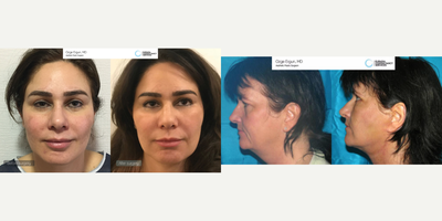 45-54 year old woman treated with Facelift - Facelift surgery performed by Ozge Ergun