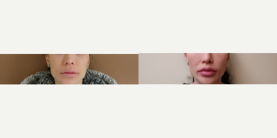 Woman treated with Lip Lift - Woman treated with Lip Lift. Patientwas dissatisfied with the long length of her upper lip and was interested in everting her lip to decrease the need for filler injections. This is a 3 month post-operative result after subnasal bullhorn lip lift.