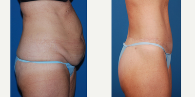 45-54 year old woman treated with Mommy Makeover - lower body lift, breast contouring along with liposuction for harmony.