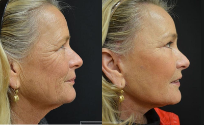 Woman treated with Facial Fat Transfer - Woman treated with Facial Fat Transfer.