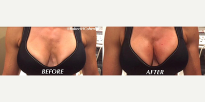 Woman treated with Nonsurgical Breast Lift - Woman treated with Nonsurgical Breast Lift