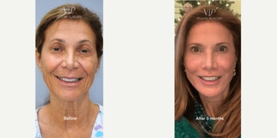 Full Facial Rejuvenation with Deep Plane Facelift with Necklift by Dr. Myung Ju Lee - Surgeries performed by Dr. Myung Ju Lee of VIP Plastic Surgery Korea. Surgeries performed: 1. Extended deep plane facelift: Ear-crease incision; SMAS layer dissection into the cheek and deep tissues repositioned.2. Platysmal necklift: Incision extends behind the ear; SMAS and loose neck skin lifted for a smoother neck.3. Middle neck plication: Tiny under-chin incision; neck muscles tied to refine the jaw and neck line.4. Temple lift: Hairline incision; outer brow and temple tissues subtly elevated.5. Lip lift: Skin below the nose reduced, shortening the philtrum and raising the upper lip.6. Upper blepharoplasty with Ptosis correction: Extra upper eyelid skin trimmed, eyelid muscle tightened, hollow areas filled with micro-fat grafting.7. Lower blepharoplasty: Under-eye fat repositioined, excess skin removed, canthopexy was performed to keep the lower eyelid firm.8. Fat grafting: Harvested fat injected into forehead, temples, cheeks, nasolabial folds for volume restoration.