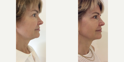 ThermiTight Neck & Jowels - The 62-year-old female patient was concerned with her sagging neck and jowls. ThermiTight is a nonsurgical, minimally invasive skin tightening treatment.
