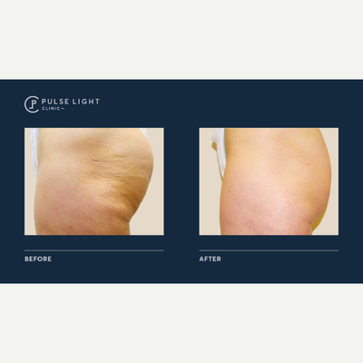 35-44 year old woman treated with Velashape - 35-44 year old woman treated with Velashape on bum / buttocks area