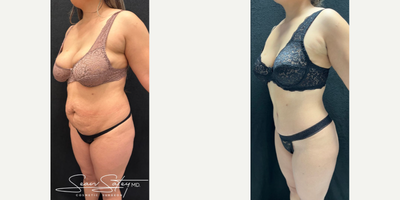 Woman treated with Lymphatic Massage - Woman treated with Vaser Liposuction of the posterior flanks and upper/middle/lower back, high definition Tummy Tuck with muscle plication, Brazilian Butt Lift, and 6 sessions of Lymphatic Massage.