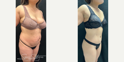 Woman treated with Lymphatic Massage - Woman treated with Vaser Liposuction of the posterior flanks and upper/middle/lower back, high definition Tummy Tuck with muscle plication, Brazilian Butt Lift, and 6 sessions of Lymphatic Massage.