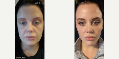 Woman treated with Lower Facelift, Facial Fat Transfer - Woman treated with Lower Facelift, Facial Fat Transfer