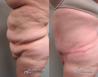 45-54 year old woman treated with Panniculectomy - 6 months after panniculectomy