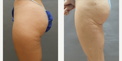 Woman treated with Liposuction - Woman treated with Liposuction