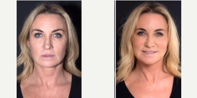 45-54 year old woman treated with Silhouette Soft - Silhoutte Soft