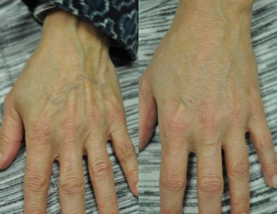 Woman treated with Hand Rejuvenation - Woman treated with Hand Rejuvenation using 1.5 cc Juvederm Ultra Plusto restore lost volume, reduce visibility of veins and tendons, shown 2 weeks post op.