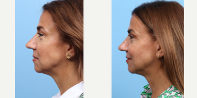 55-64 year old woman treated with Nonsurgical Facelift, Botox - Dr. Wise performed a liquid facelift on this 58-year-old patient using a combination of Botox and dermal fillers. The fillers were strategically injected into the cheeks to contour and subtly lift, diminish under-eye hollows, and add volume. Additionally, Botox was also injected to smooth overall wrinkled skin.