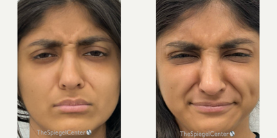 18-24 year old woman treated with Xeomin - Botulinum