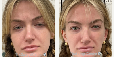 18-24 year old woman treated with Xeomin - Botulinum