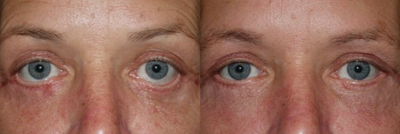 35-44 year old woman treated with Eyelid Retraction Repair - Lower lid retraction repairMidface lift CanthoplastyHard palate graft(attn. highly improved lower lid position)