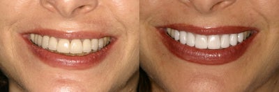 Tetracycline Stains treated with Veneers - This woman had seen another dentist for veneers to cover her striped teeth due to antibiotic use as a child.&nbsp; The first set was monochromatic and not white enough for her satisfaction.&nbsp; After 8 veneers, she was very happy, especially since she did NOT need full crown coverage of her teeth...!
