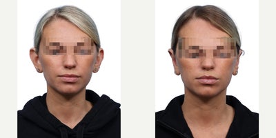 28 year old woman treated with Ear Surgery - This 28-year-old was bothered by the appearance of protruding ears. She underwent otoplasty, achieving a more natural, balanced ear contour that complements her facial features.