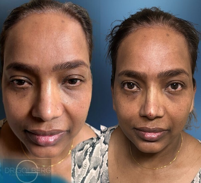 Woman treated with Nonsurgical Nose Job - Woman treated with Nonsurgical Nose Job