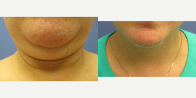 55-64 year old woman treated with Neck Lift, Facelift, MACS Facelift, SMAS Facelift, Lower Facelift, Mini Facelift - 64 year old female before and 1 day after mini facelift and mini neck lift (small submental scar). Notice there is no bruising. She is happy with the results.
