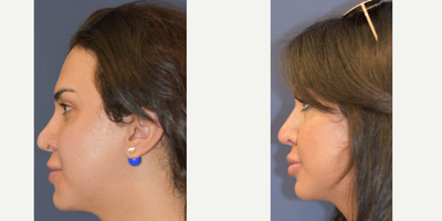 25-34 year old woman treated with Juvederm - Juverderm used for non-surgical nose revision rhinoplasty & lip augmentation