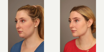 Woman treated with Smart Lipo - Woman treated with Chin Liposuction through Smart Lipo. Pre-op, patient had fullness behind her chin since childhood, regardless of her weight.