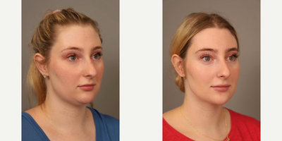 Woman treated with Smart Lipo - Woman treated with Chin Liposuction through Smart Lipo. Pre-op, patient had fullness behind her chin since childhood, regardless of her weight.