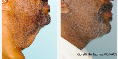 55-64 year old man treated with Facelift - Lower face and neck lift