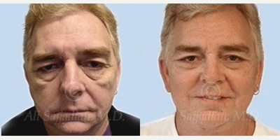 Man treated with Eyelid Surgery - Eyelid Surgery