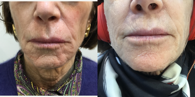 65-74 year old woman treated with Laser Treatment - Pt treated with Resurix along with fillers periorally