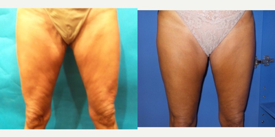 35-44 year old woman treated with Cellulaze - This is a 36 year old female who consulted with Dr. Greenberg because she was unhappy with the severe dented appearance of her thighs.  She wanted to accomplish a smoother appearance.