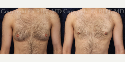 23 year old patient treated with FTM Keyhole Chest Masculinization Surgery - This 23 year old F-M transgender patient has been living full time as a male for 4 years, on Testosterone for 4 years, and has been binding his breasts for 3 years. He came to Dr. Tholen not only because of a friend's referral, but also for his nearly 3 decades of experience with non-genital transgender surgery. He underwent outpatient keyhole (periareolar incision only) total mastectomies (top surgery) in our AAAASF-accredited on-site surgical facility. His TIVA anesthesia permitted rapid, no-nausea wake-up, and discharge from our recovery room in one hour. His after photos show his appearance at just over 3 weeks post-op. Secondary nipple (papilla only) reduction surgery is recommended under local anesthesia separate from mastectomies due to blood supply considerations.