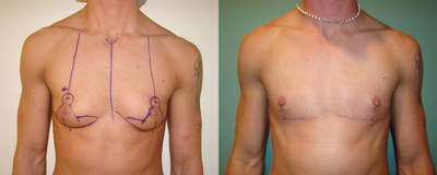 Top Surgery FTM chest masculinization - 20 year-old patient who was an A cup to start, and already had excellent muscular definition; shown with pre-op markings and approximately 1 month post-op (and fresh incisions, which faded).