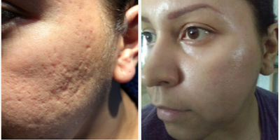 Woman treated with MiXto Laser, Venus Viva - Details - Acne treated with lasers and fillers