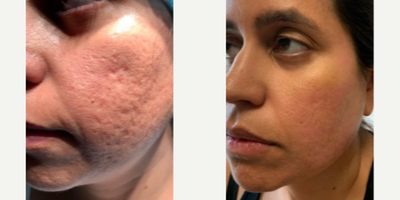 Woman treated with MiXto Laser, Venus Viva - Details - Acne treated with lasers and fillers