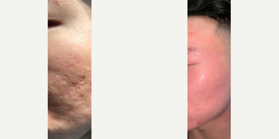 Man treated with MiXto Laser, Venus Viva - Details - Acne treated with lasers and fillers