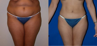 28 year old woman treated with SAFELipo - This is an example of how someone's skin can tighten up after SAFE Liposuction if their skin quality is good.