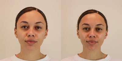 25-34 year old woman treated with Microdermabrasion - Microdermabrasion treatment on 26 year old woman